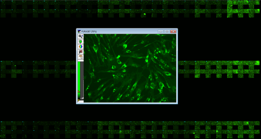 First High-Throughput Screen on NPC patient-derived fibroblasts